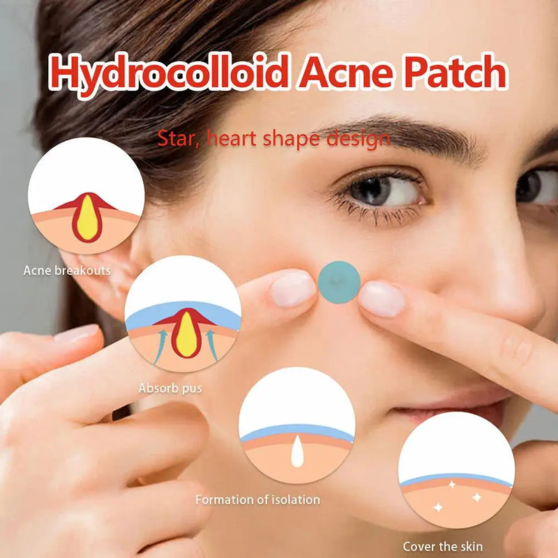 Invisible Acne Pimple Patches - 144pcs, 2 Sizes, Fast Healing