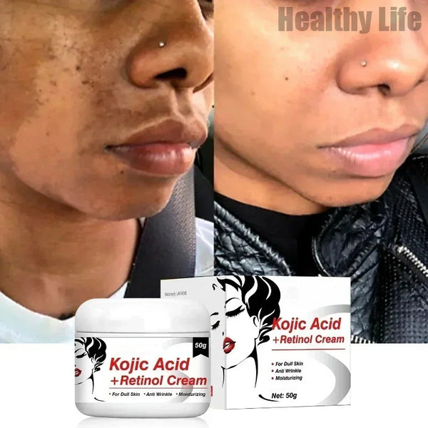 Kojic Acid Retinol Cream - Skin Brightening, Melasma & Fine Line Fading, Moisturizing Care for Women